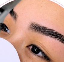 Brows after a brow lift